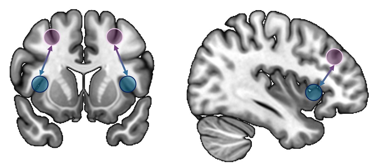 Two brain slices with the dorsolateral prefrontal cortex in purple and the insula in blue, linked by arrows